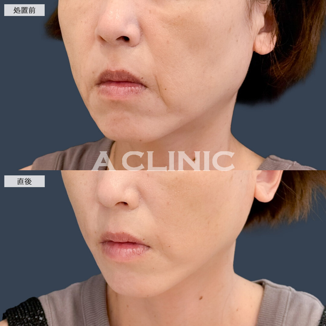 Aスレッドはダウンタイム少なくしわを引き上げアンチエイジング効果が期待できます！こちら処置前と直後の症例です(40代女性)