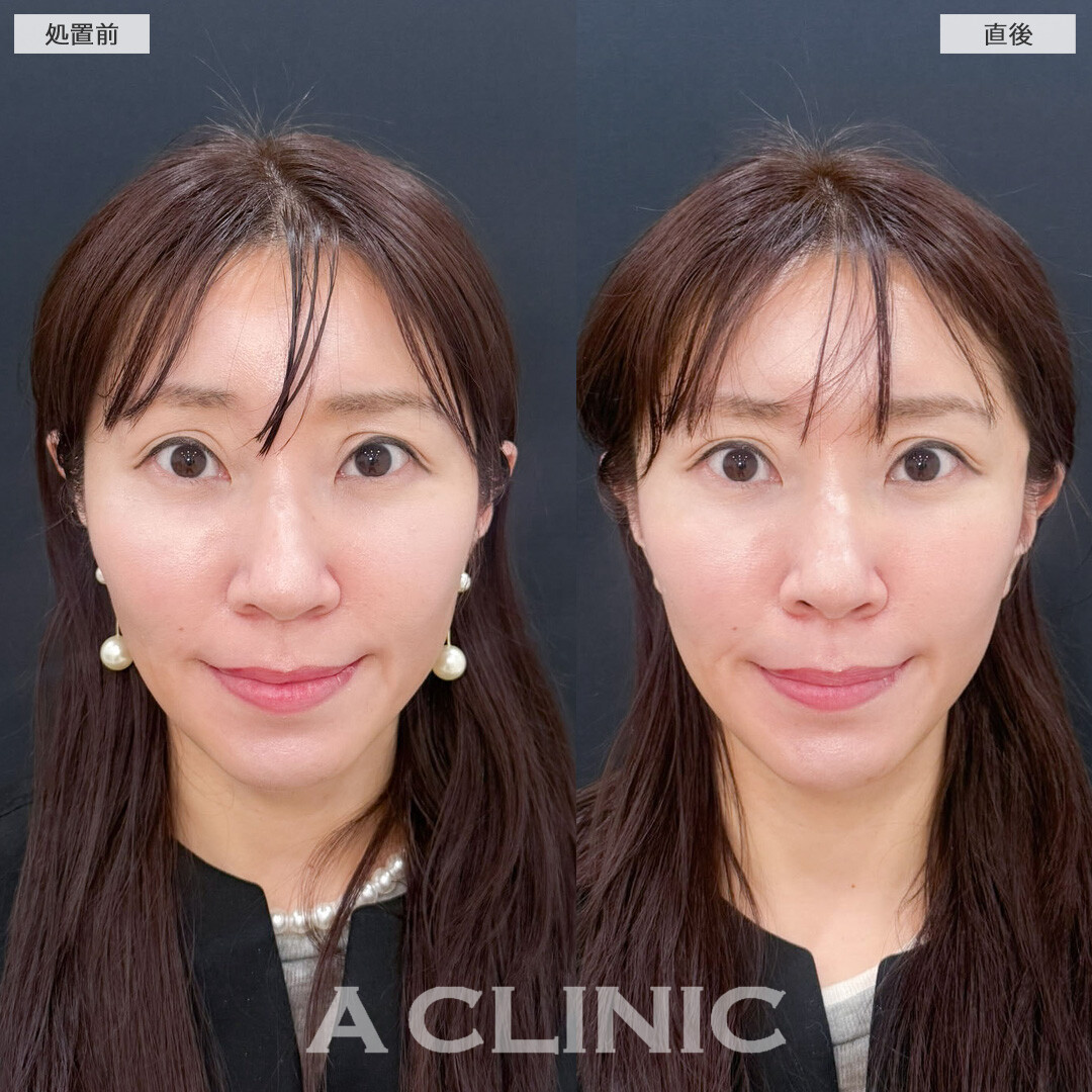 Aスレッドで気になってきたたるみも即引き上げ理想の小顔に！こちら処置前と直後の症例です(30代女性)