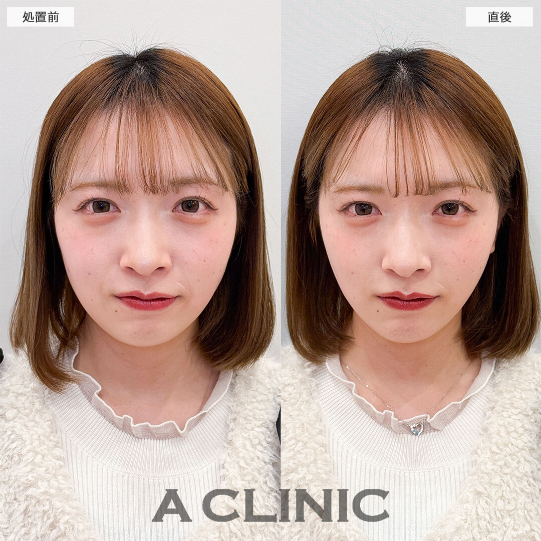 Aスレッドでもたつき解消し理想のフェイスラインに！こちら処置前と直後の症例です(20代女性)