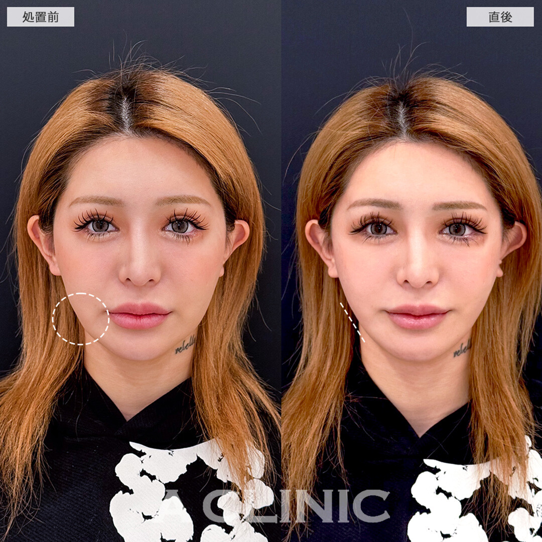 Aスレッドでもたつきを即日解消しスッキリフェイスラインへ!こちら処置前と直後の症例です(20代女性)