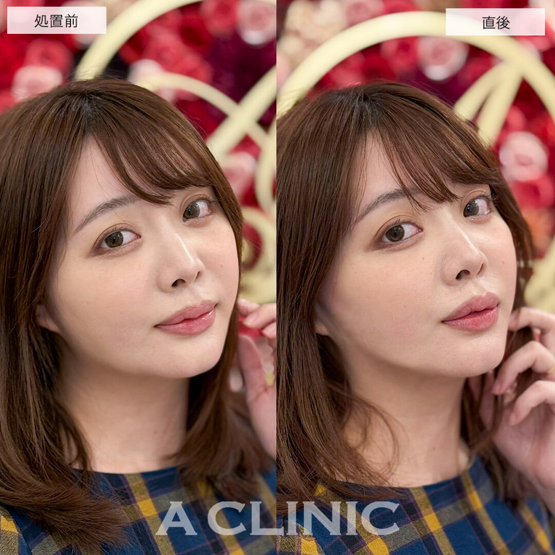 Aスレッドは頬コケせずにリフトアップが可能です!こちら処置前と直後の症例です(30代女性)