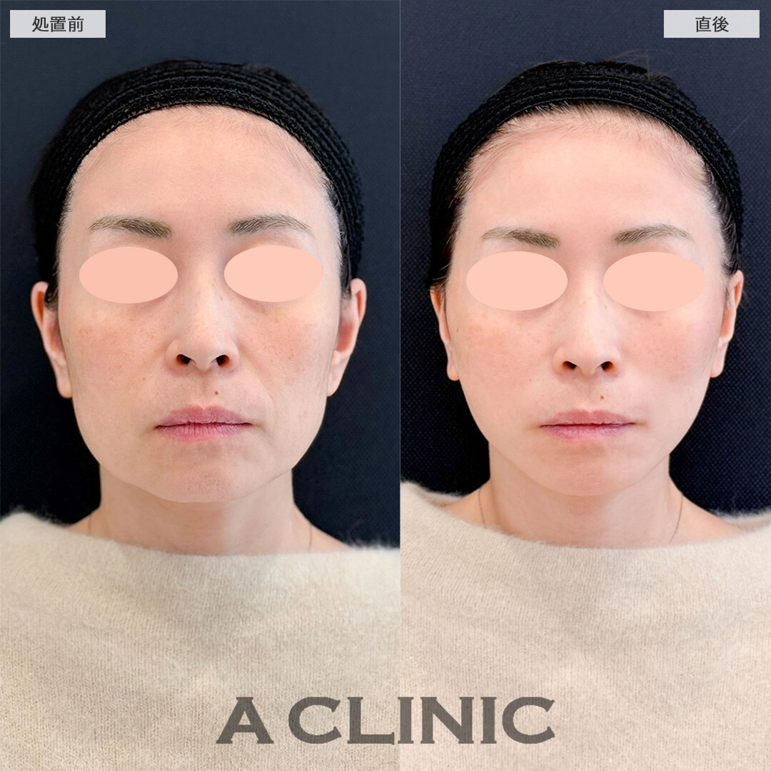 Aスレッドで気になるフェイスラインのたるみが改善し若返りに成功しました！こちら処置前と直後の症例です(40代女性)