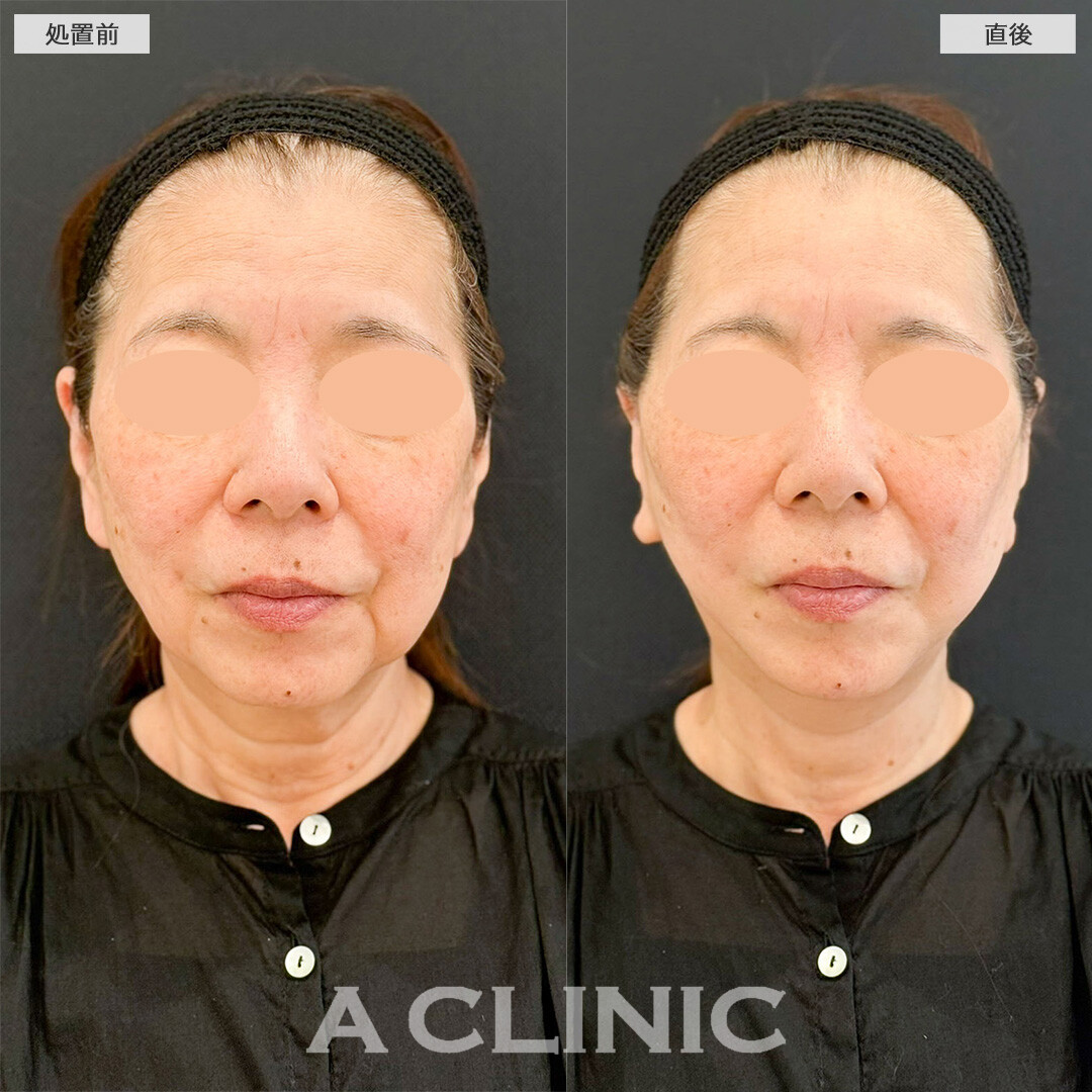Aスレッドでフェイスラインをリフトアップしほうれい線やマリオネットラインのしわも改善！処置前と直後の症例です(60代女性)