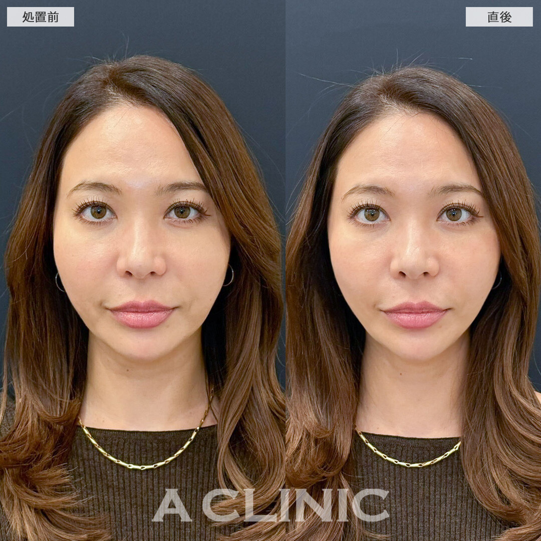 Aスレッドの定期的なメンテナンスでたるみ知らずのフェイスライン保てます！こちら処置前と直後の症例です(30代女性)