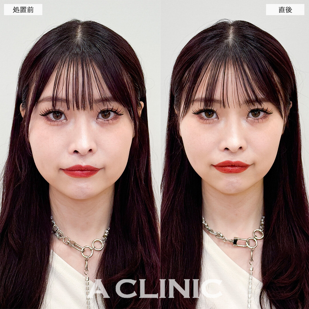 Aスレッドでフェイスラインの左右差が改善しました！処置前と直後の症例です(20代女性)