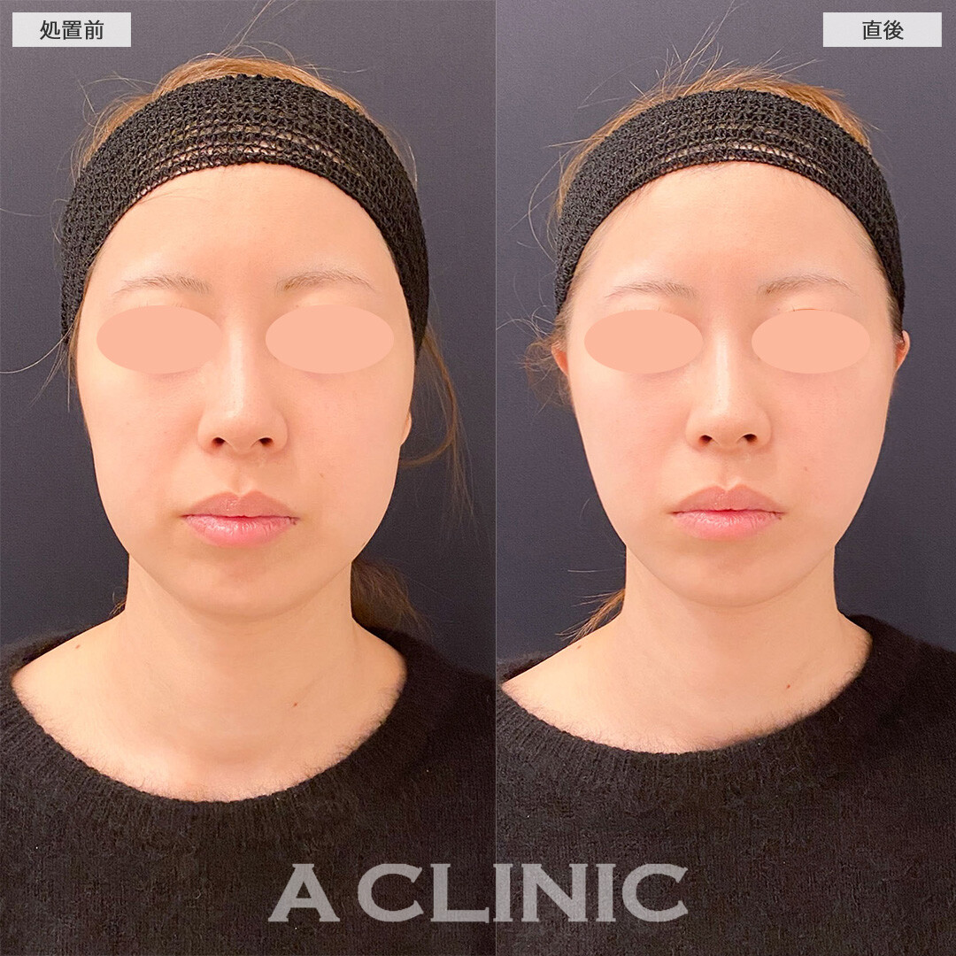 Aスレッドで直後から下顔面のもたつき改善！処置前と直後の症例です(20代)