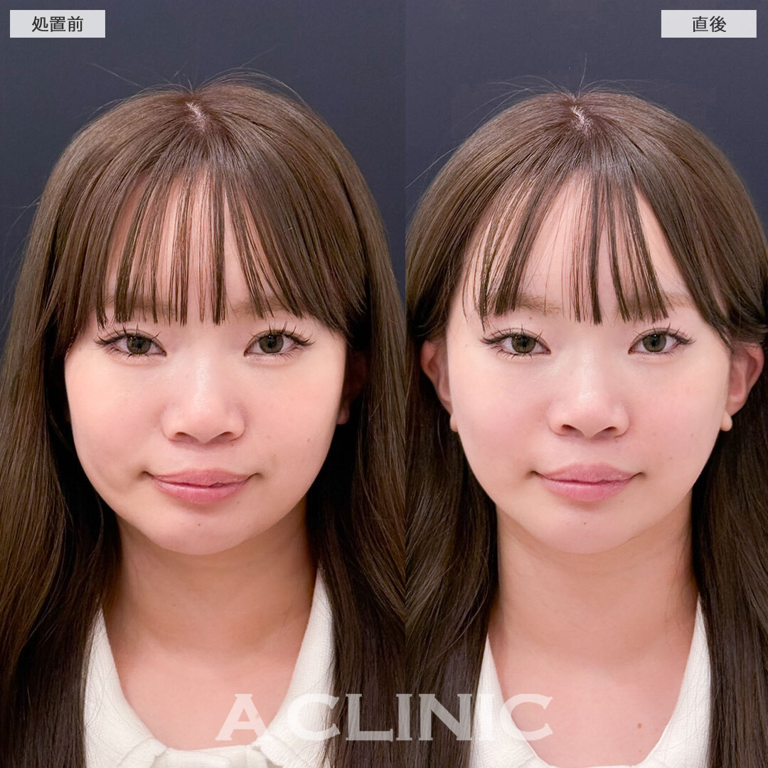 Aスレッドとヒアルロン酸注射(シワ)で輪郭の左右差とマリオネットラインを同時に改善！こちら処置前と直後の症例です(20代女性)