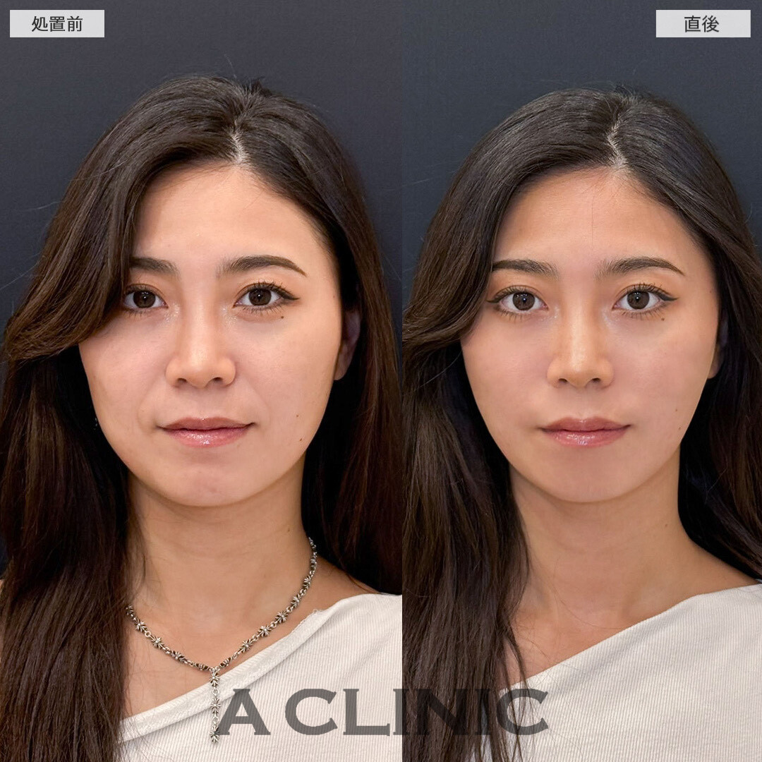 Aスレッドでお悩みだったほうれい線改善し美人度アップしました！こちら処置前と直後の症例です(30代女性)