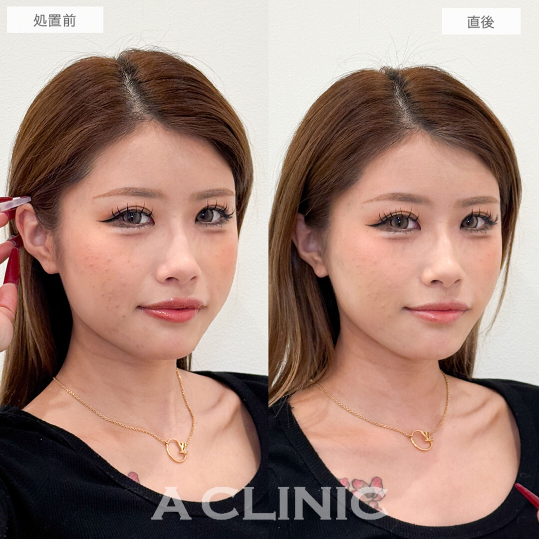 Aスレッドとあごへのヒアルロン酸注入で輪郭が整い綺麗な卵型に！処置前と直後の症例です(20代女性)