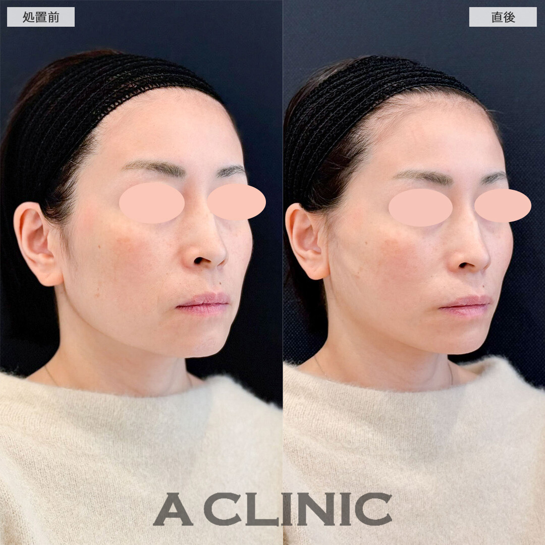 Aスレッドで気になるフェイスラインのたるみが改善し若返りに成功しました！こちら処置前と直後の症例です(40代女性)
