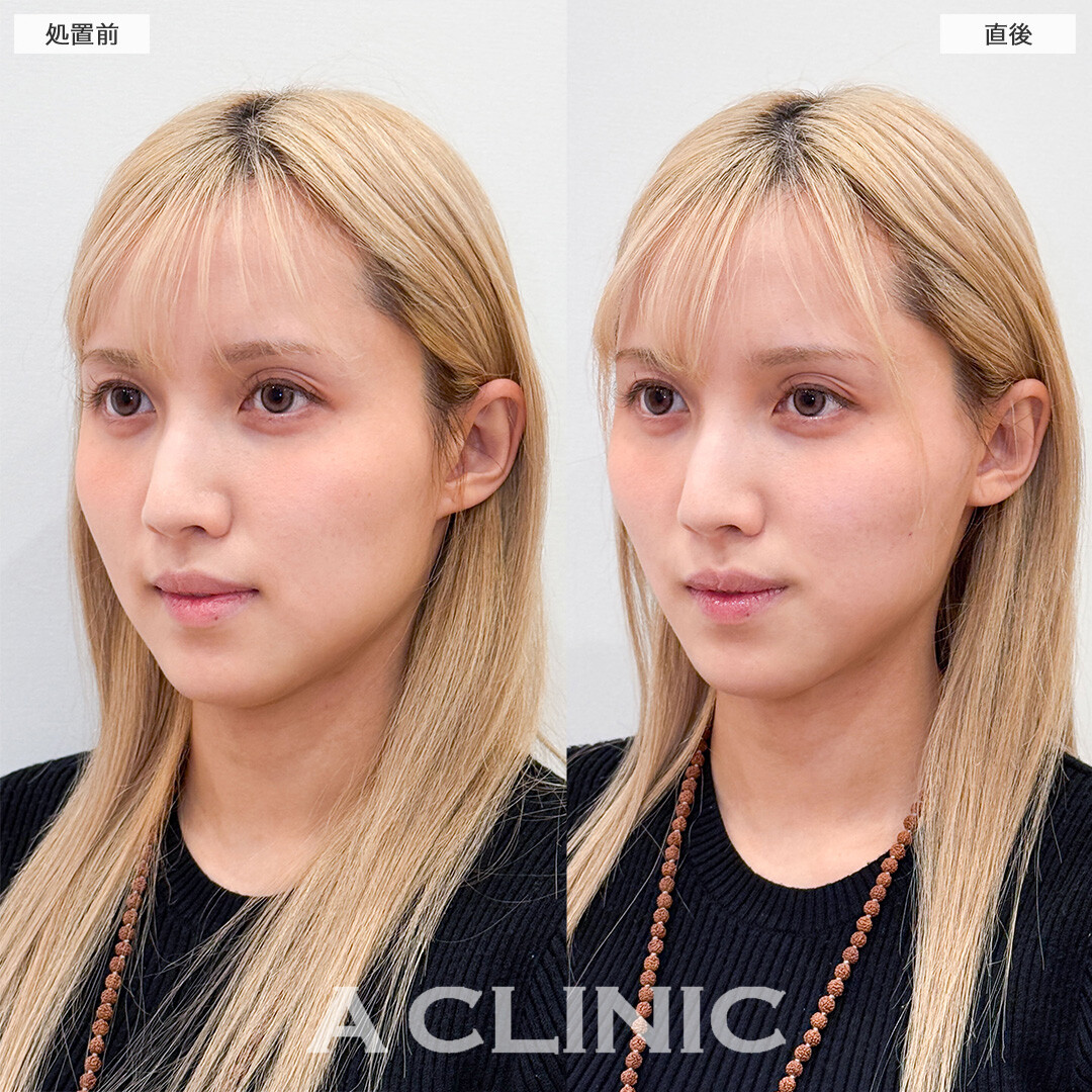 Aスレッドと頬へのヒアルロン酸注入で余分なたるみを引き上げ頬コケも改善！こちら処置前と直後の症例です(20代女性)
