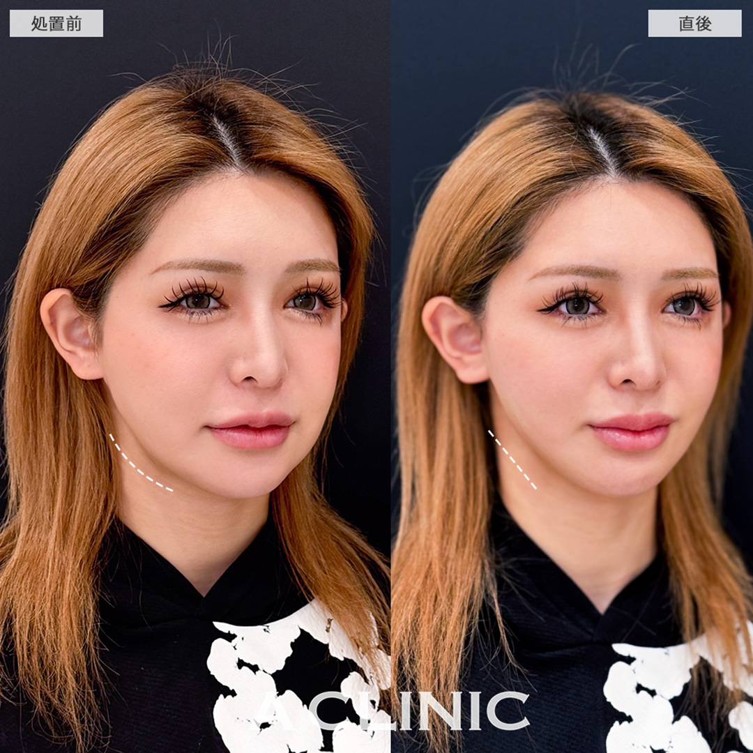 Aスレッドでもたつきを即日解消しスッキリフェイスラインへ!こちら処置前と直後の症例です(20代女性)