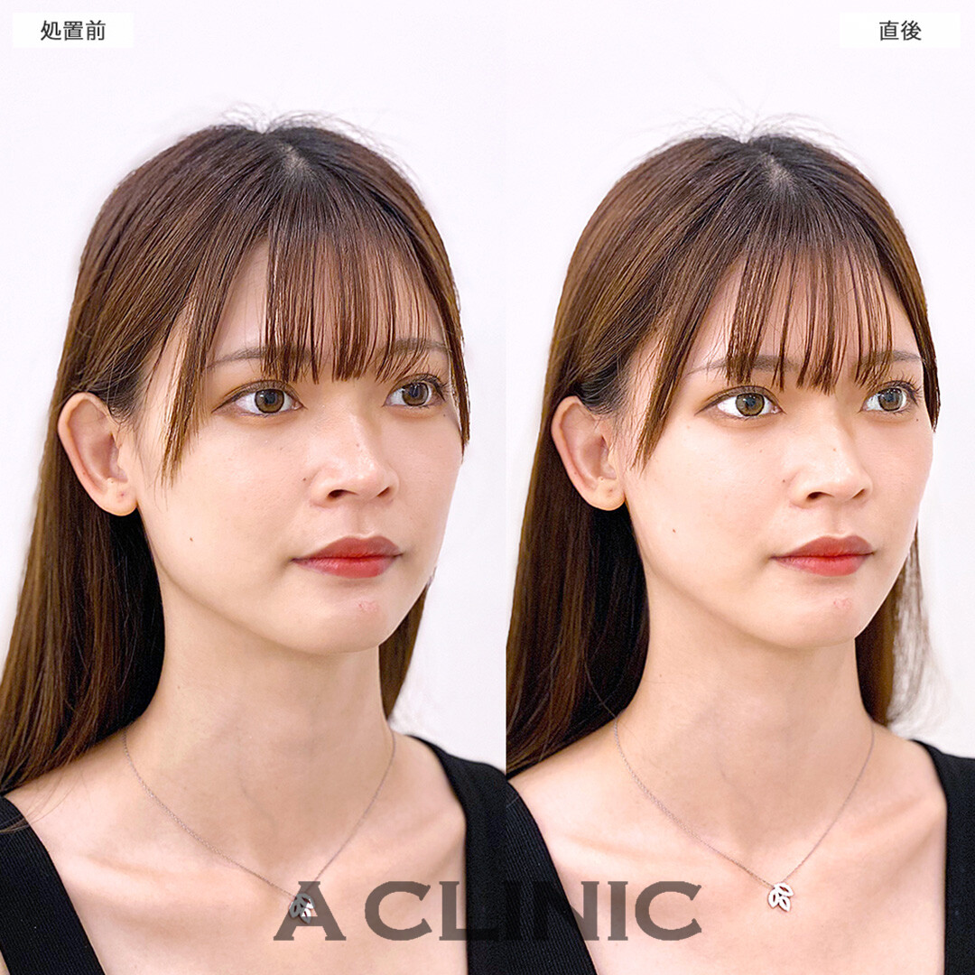 Aスレッドで小顔美女がさらに即日美しくなりました!こちら処置前と直後の症例です(20代女性)