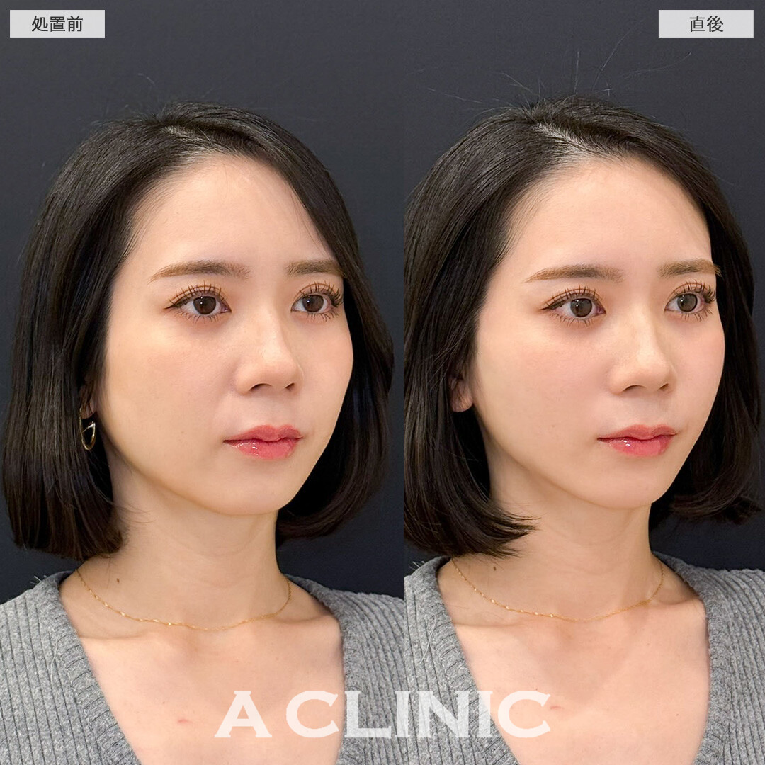 Aスレッドを定期的に行うことでたるむ前に予防できます！こちら処置前と直後の症例です(30代女性)