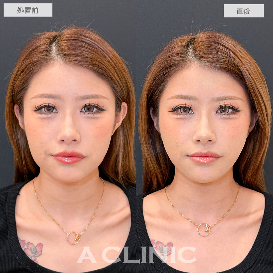 Aスレッドとあごへのヒアルロン酸注入で輪郭が整い綺麗な卵型に！処置前と直後の症例です(20代女性)