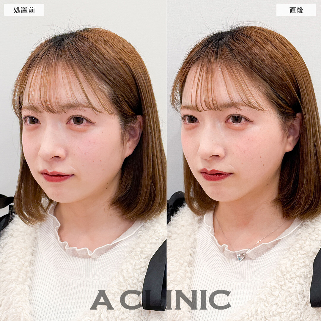 Aスレッドでもたつき解消し理想のフェイスラインに！こちら処置前と直後の症例です(20代女性)