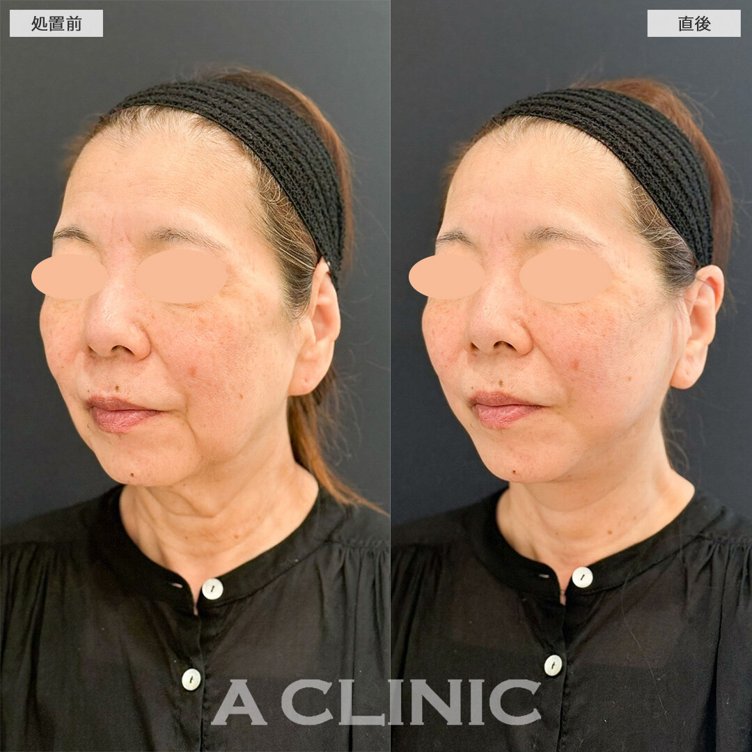 Aスレッドでフェイスラインをリフトアップしほうれい線やマリオネットラインのしわも改善！処置前と直後の症例です(60代女性)