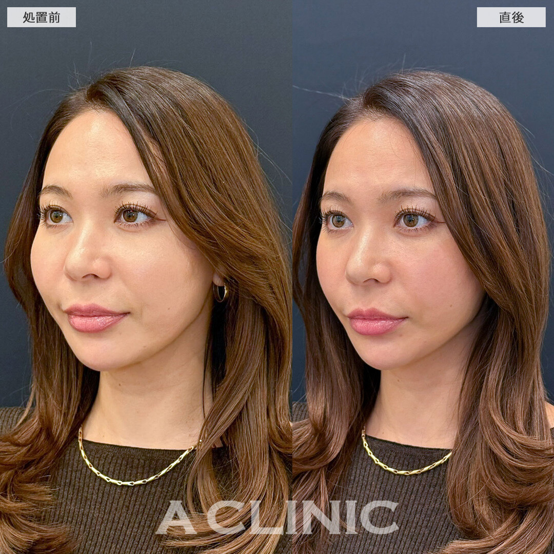 Aスレッドの定期的なメンテナンスでたるみ知らずのフェイスライン保てます！こちら処置前と直後の症例です(30代女性)