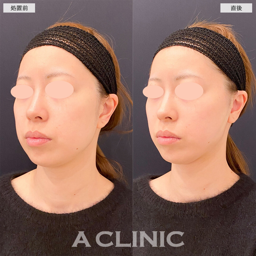 Aスレッドで直後から下顔面のもたつき改善！処置前と直後の症例です(20代)