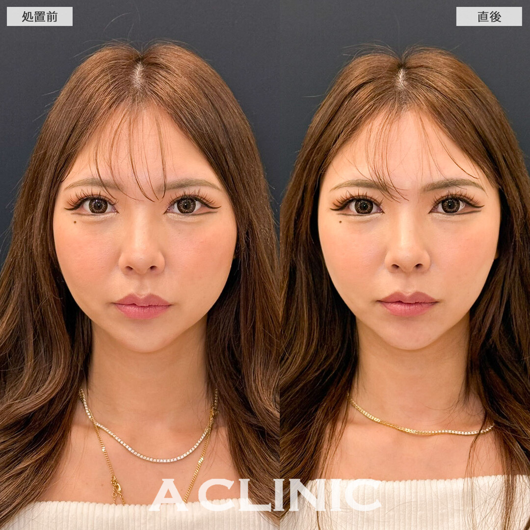 Aスレッドを定期的に受けることでたるみも怖くない！こちら処置前と直後の症例です(30代女性)