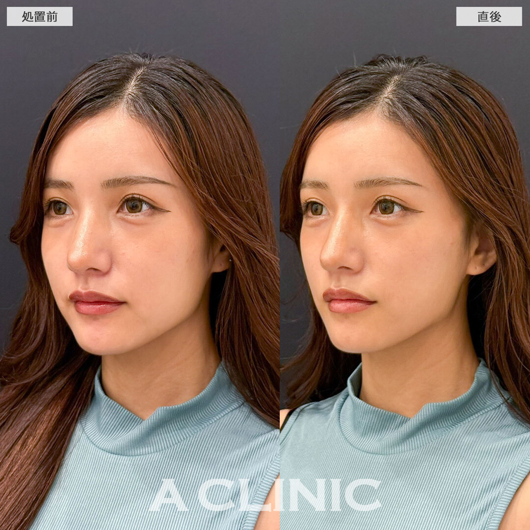 Aスレッドで口元のもたつき改善しより美しくなりました！こちら処置前と直後の症例です(20代女性)