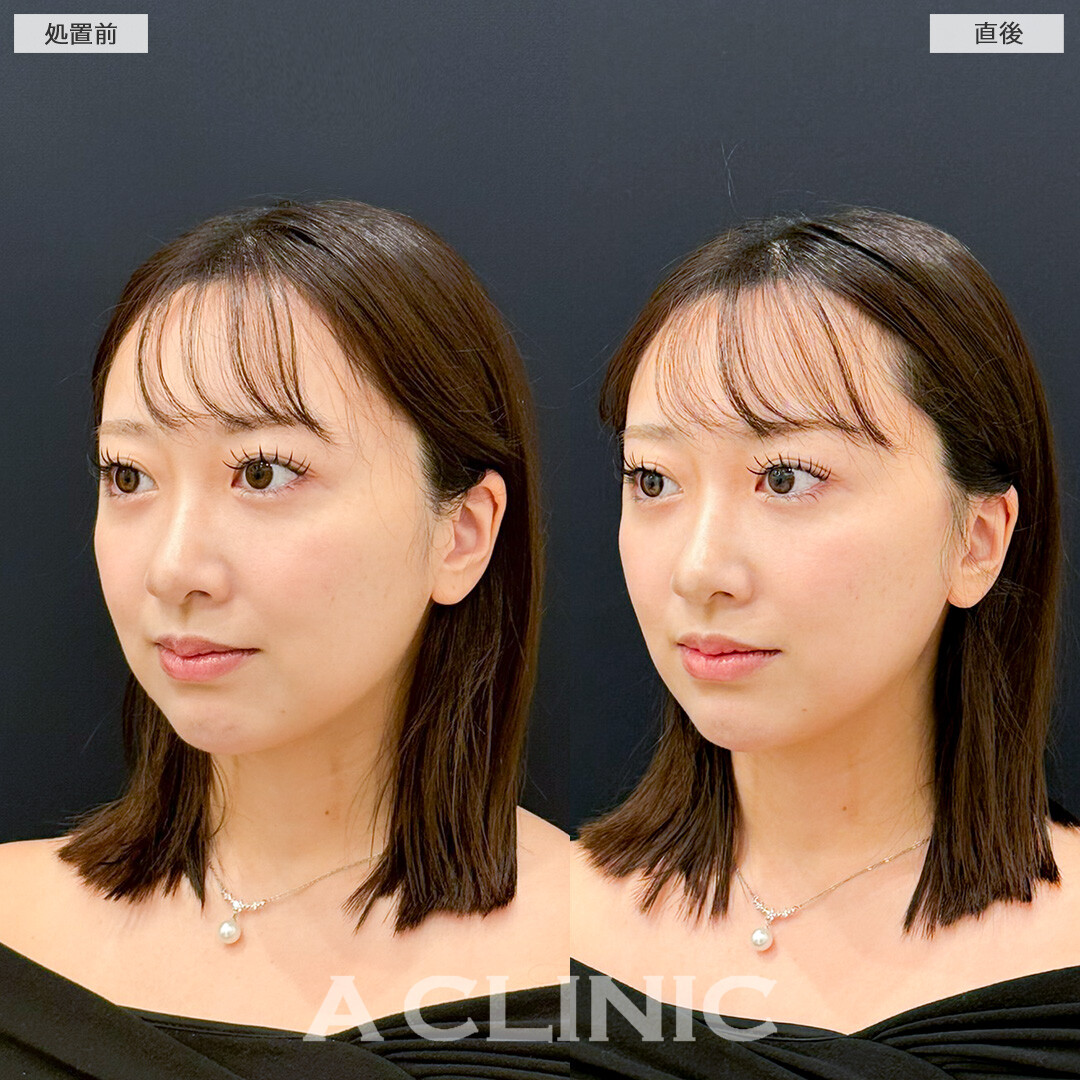Aスレッドで左右のバランス整え輪郭矯正！処置前と直後の症例です(20代女性)