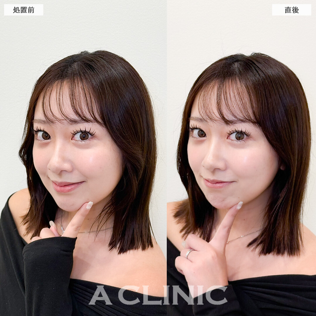 Aスレッドで左右のバランス整え輪郭矯正！処置前と直後の症例です(20代女性)