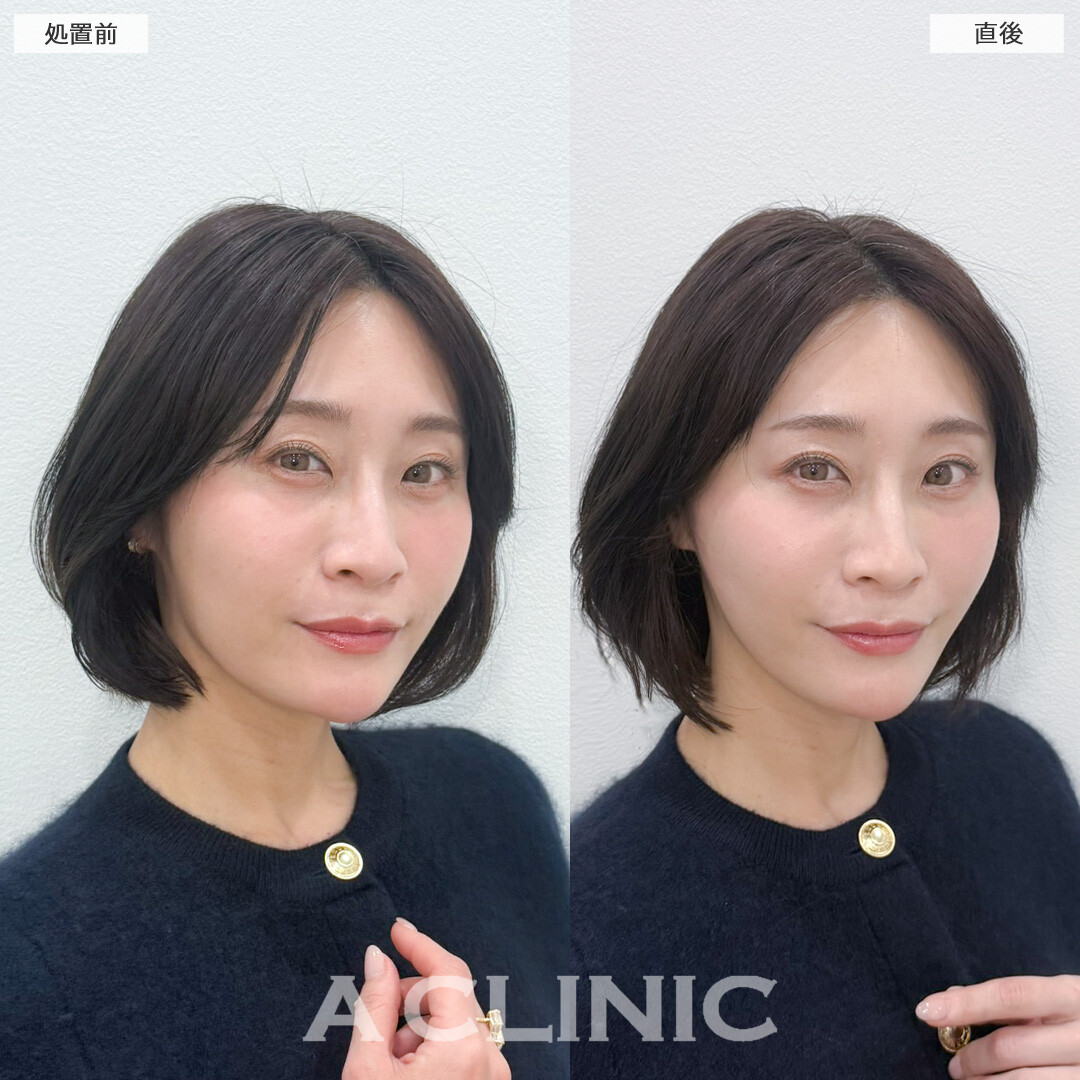 Aスレッドでほうれい線やフェイスライン引き上げてマイナス5歳を目指せます！処置前と直後の症例です(40代女性)