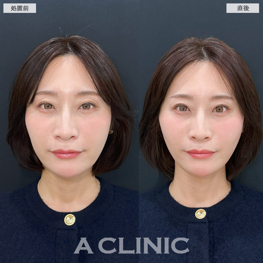 Aスレッドでほうれい線やフェイスライン引き上げてマイナス5歳を目指せます！処置前と直後の症例です(40代女性)