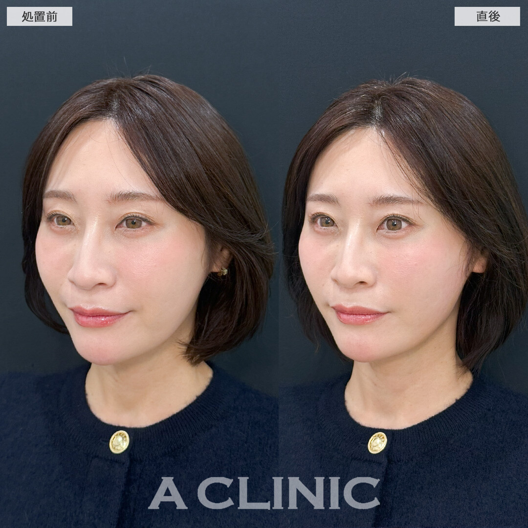 Aスレッドでほうれい線やフェイスライン引き上げてマイナス5歳を目指せます！処置前と直後の症例です(40代女性)