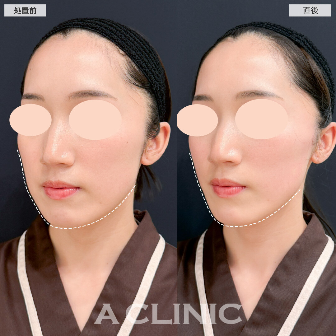 Aスレッドで輪郭の凹凸を減らしてまっすぐシャープなフェイスラインになりました！処置前と直後の症例です(20代女性)