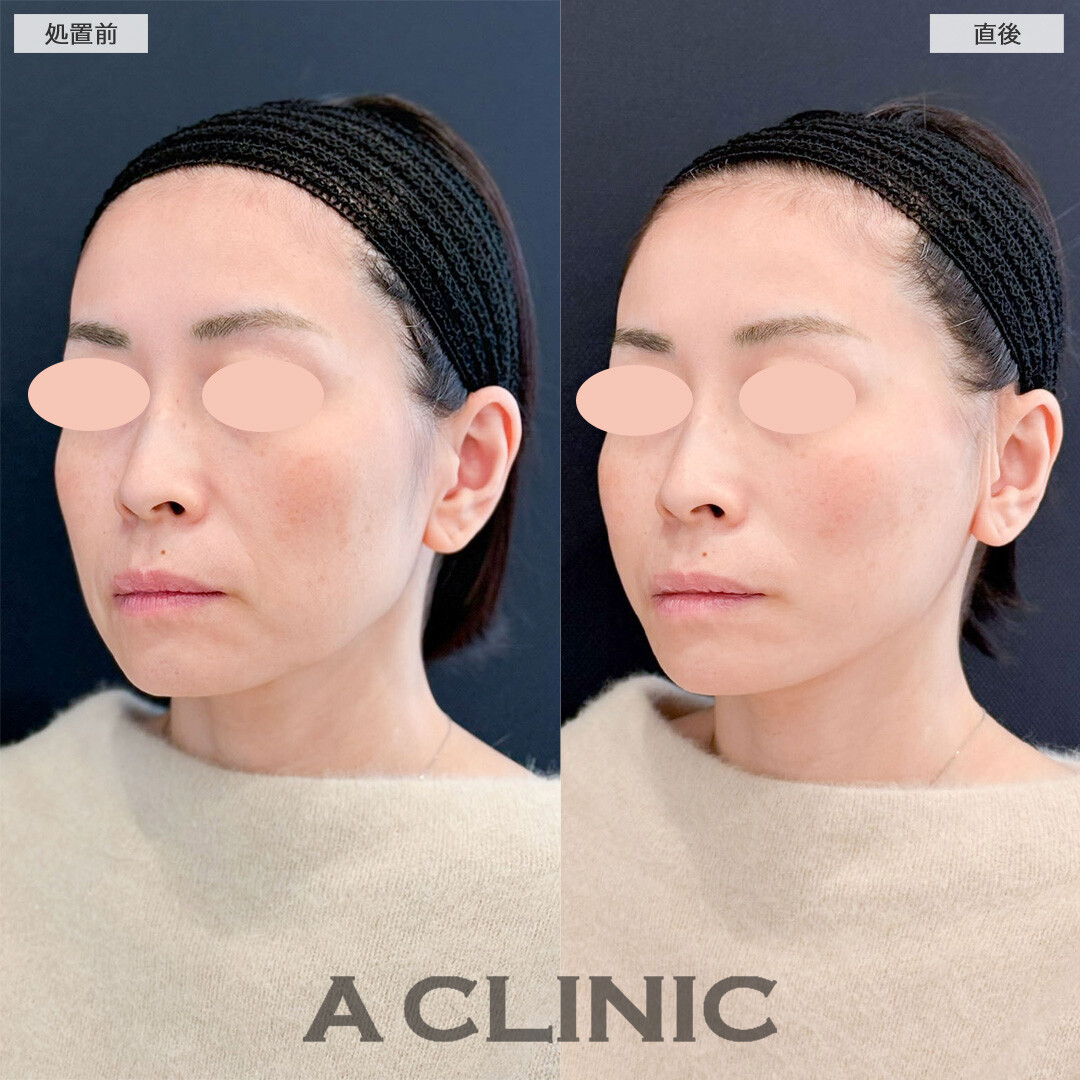 Aスレッドで気になるフェイスラインのたるみが改善し若返りに成功しました！こちら処置前と直後の症例です(40代女性)