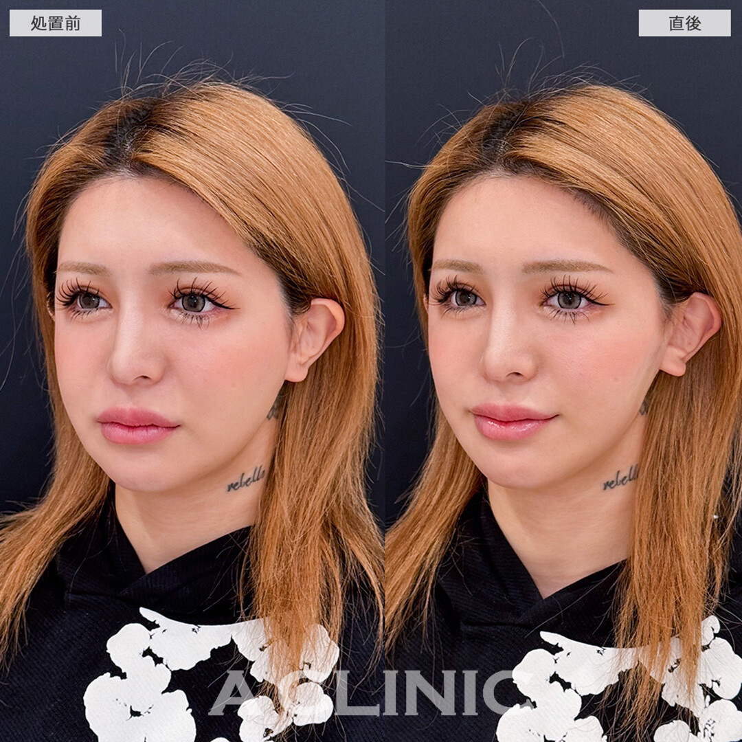 Aスレッドでもたつきを即日解消しスッキリフェイスラインへ!こちら処置前と直後の症例です(20代女性)