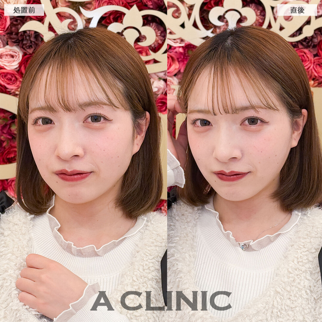 Aスレッドでもたつき解消し理想のフェイスラインに！こちら処置前と直後の症例です(20代女性)