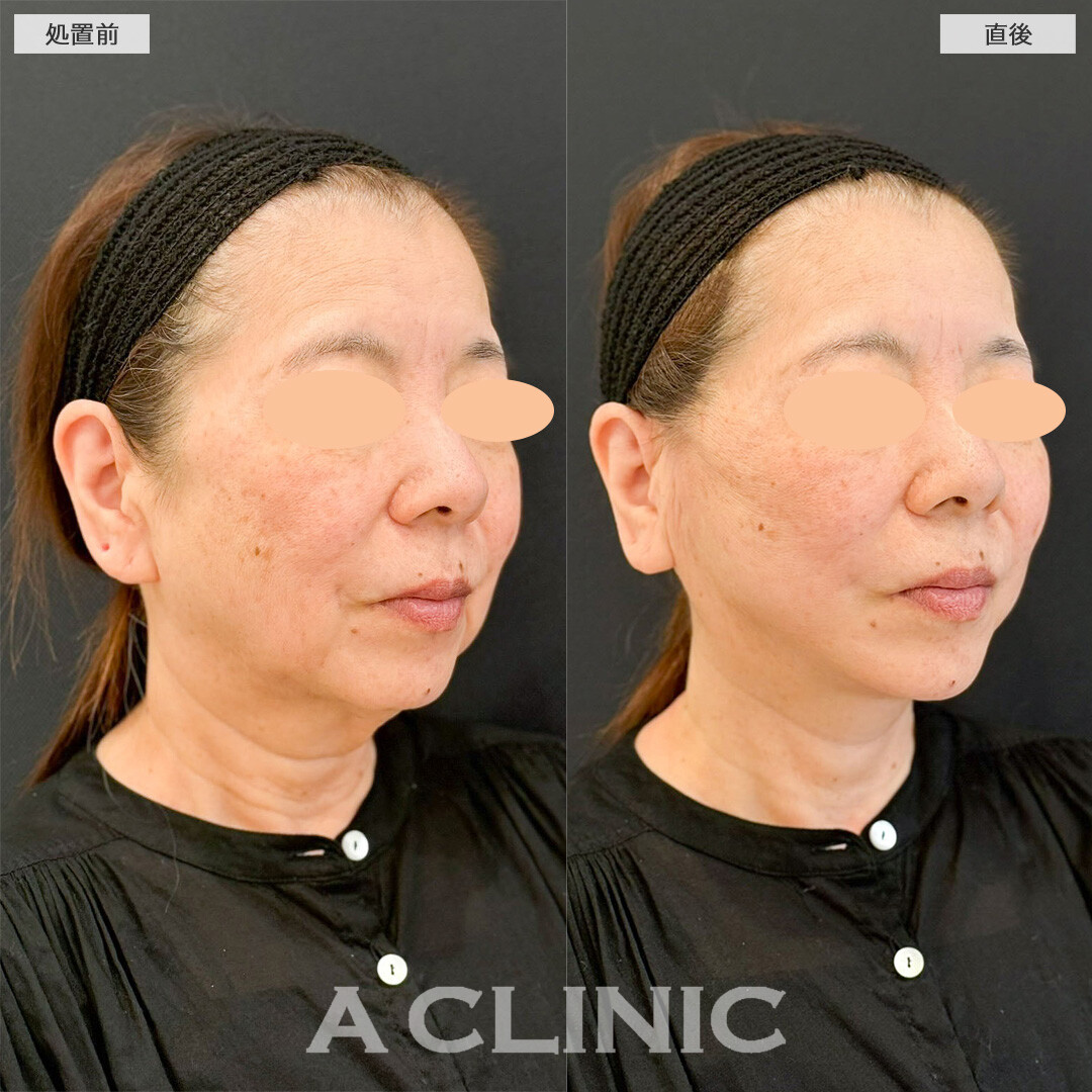 Aスレッドでフェイスラインをリフトアップしほうれい線やマリオネットラインのしわも改善！処置前と直後の症例です(60代女性)