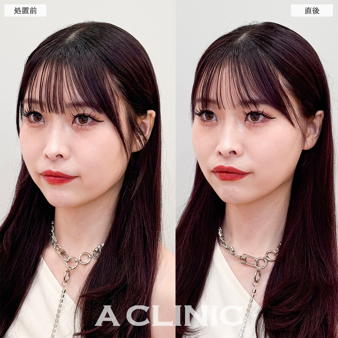 Aスレッドでフェイスラインの左右差が改善しました！処置前と直後の症例です(20代女性)