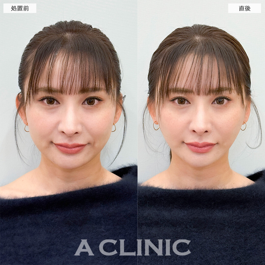 Aスレッドでたるみの無い若々しい輪郭へ！処置前と直後の症例です(30代女性)