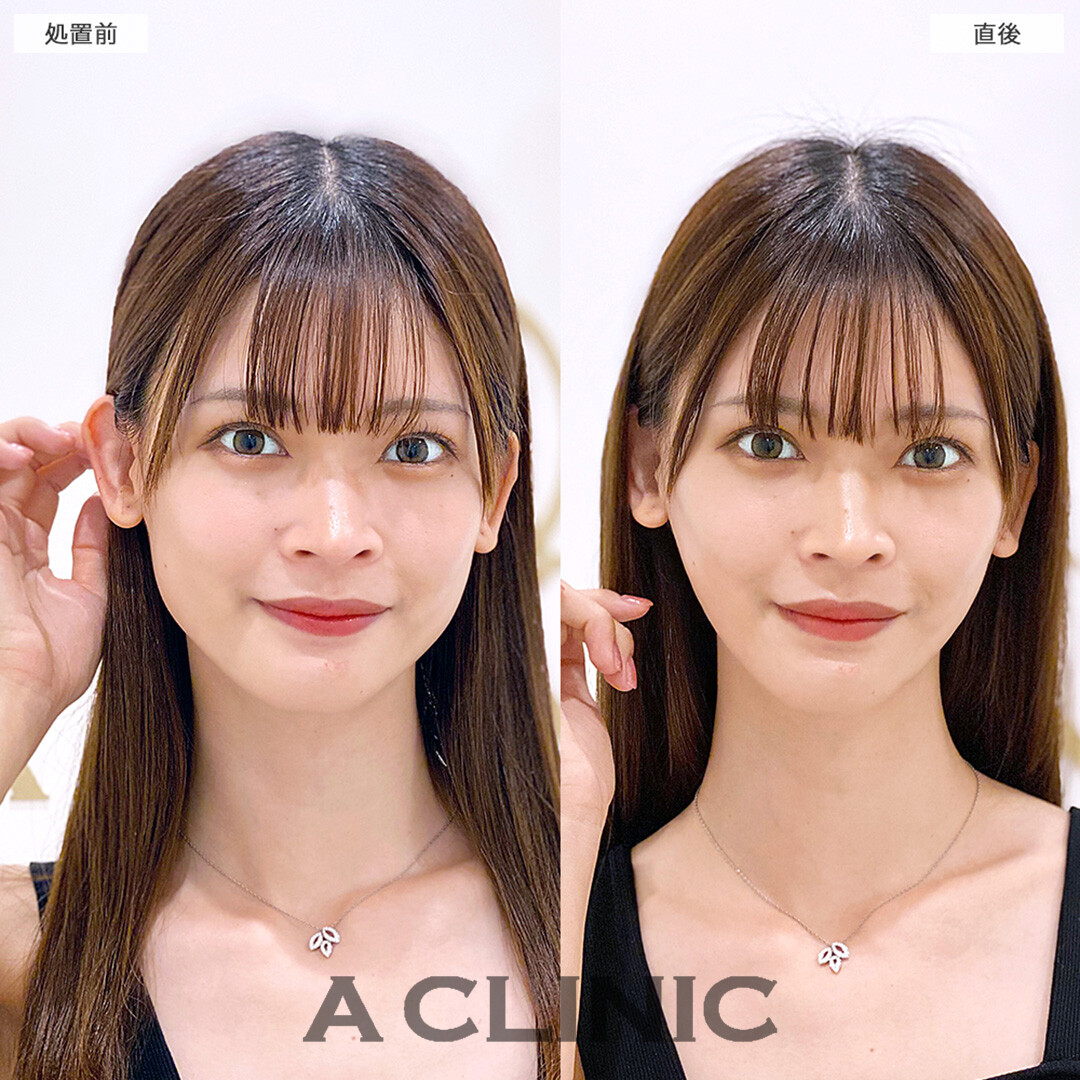 Aスレッドで小顔美女がさらに即日美しくなりました!こちら処置前と直後の症例です(20代女性)