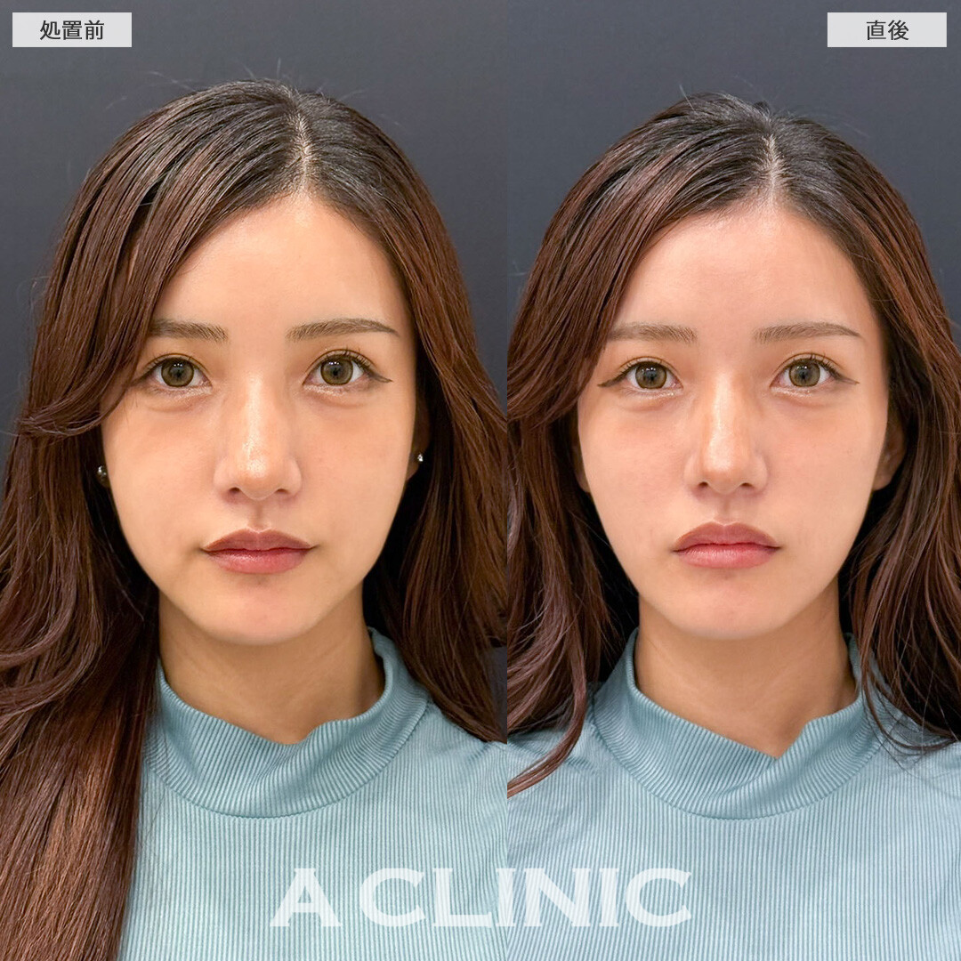Aスレッドで口元のもたつき改善しより美しくなりました！こちら処置前と直後の症例です(20代女性)