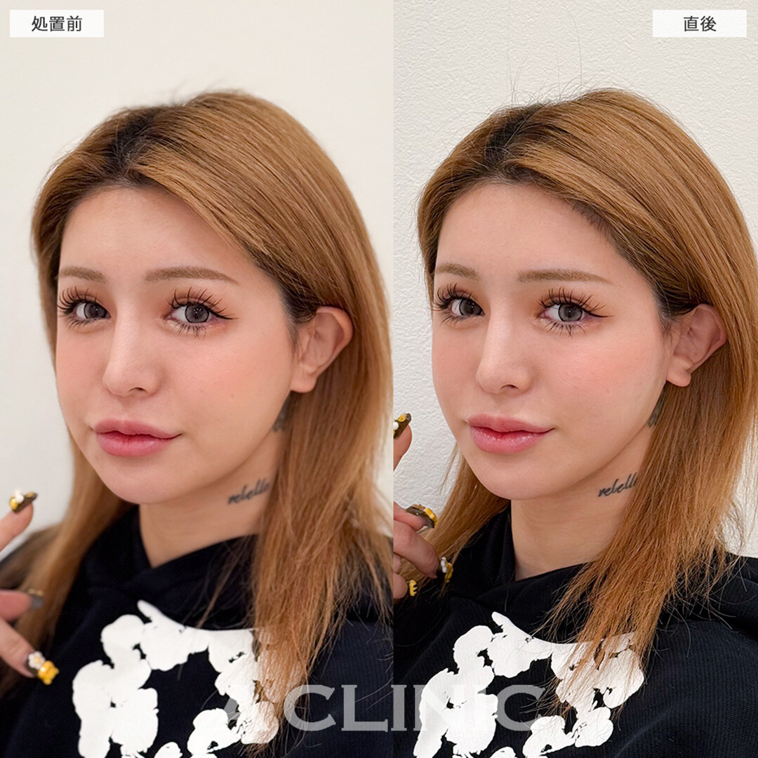 Aスレッドでもたつきを即日解消しスッキリフェイスラインへ!こちら処置前と直後の症例です(20代女性)