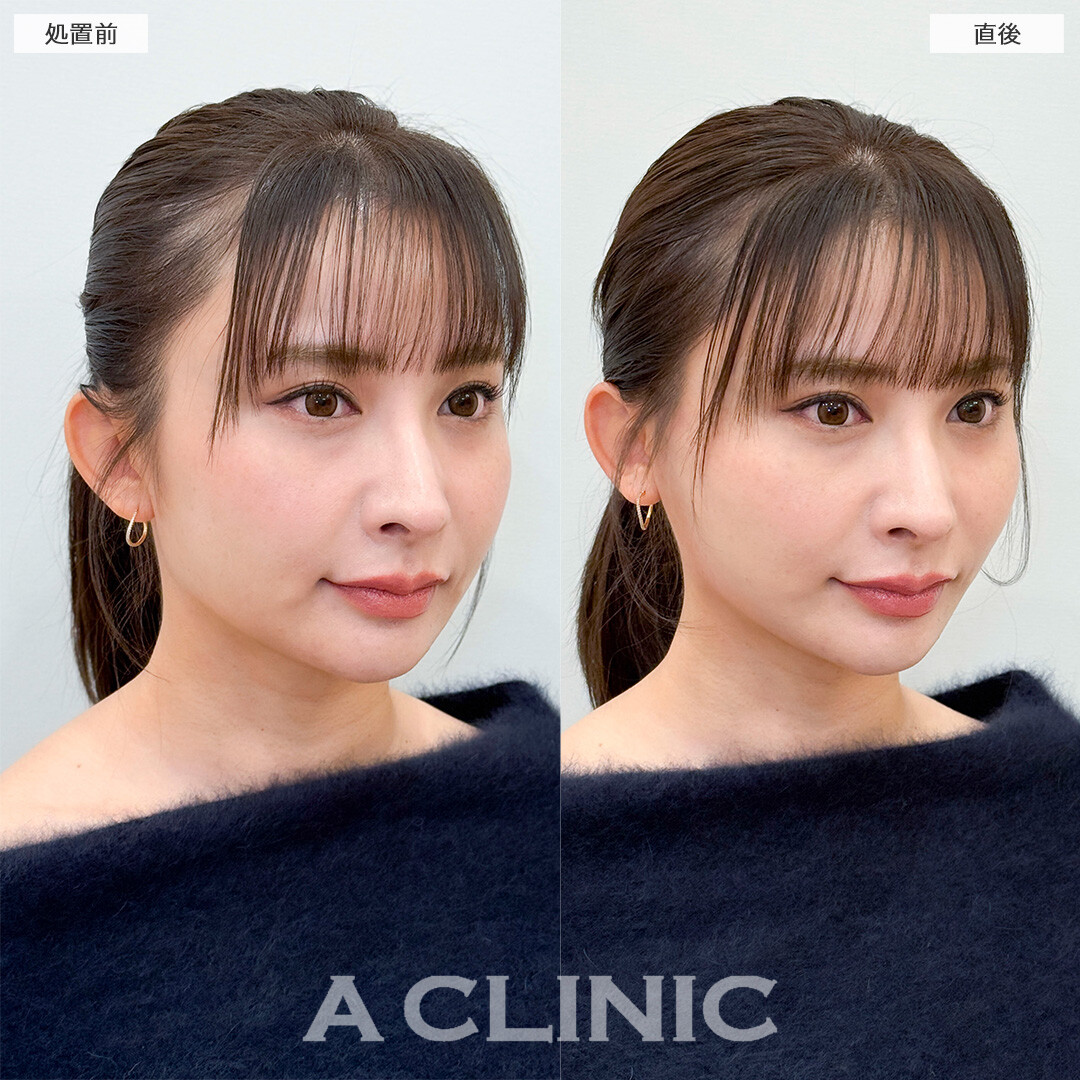 Aスレッドでたるみの無い若々しい輪郭へ！処置前と直後の症例です(30代女性)