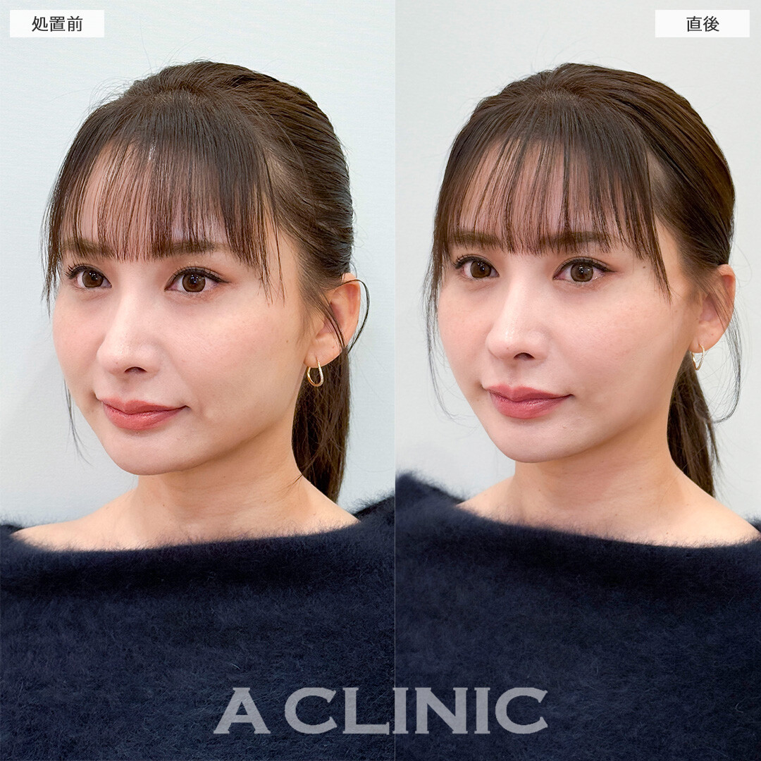 Aスレッドでたるみの無い若々しい輪郭へ！処置前と直後の症例です(30代女性)