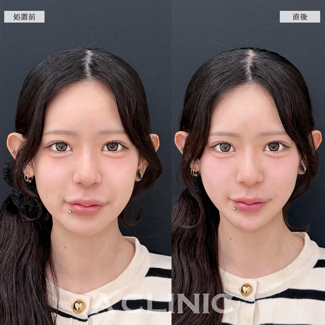 Aスレッドなら施術直後から輪郭がシュッとバランスよく整います！こちら処置前と直後の症例です(20代女性)