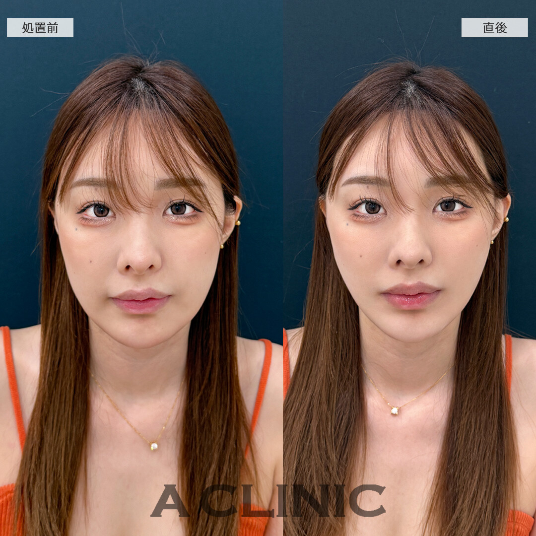 糸リフトで下顔面が整ってワンランク垢抜け！こちらAスレッドの処置前と直後の症例です(30代女性)
