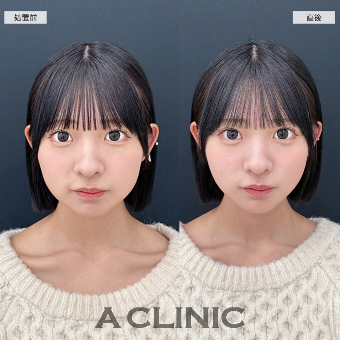 直後から丸顔感が緩和されて超スッキリ！こちらAスレッドの処置前と直後の症例です(10代女性)