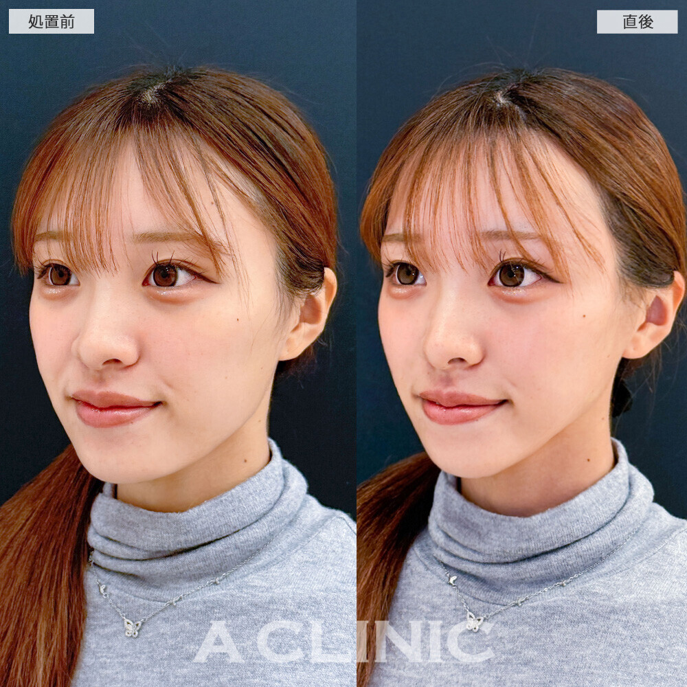 Aスレッドで輪郭のボコつきが整いました！こちら処置前と直後の症例です(20代女性)