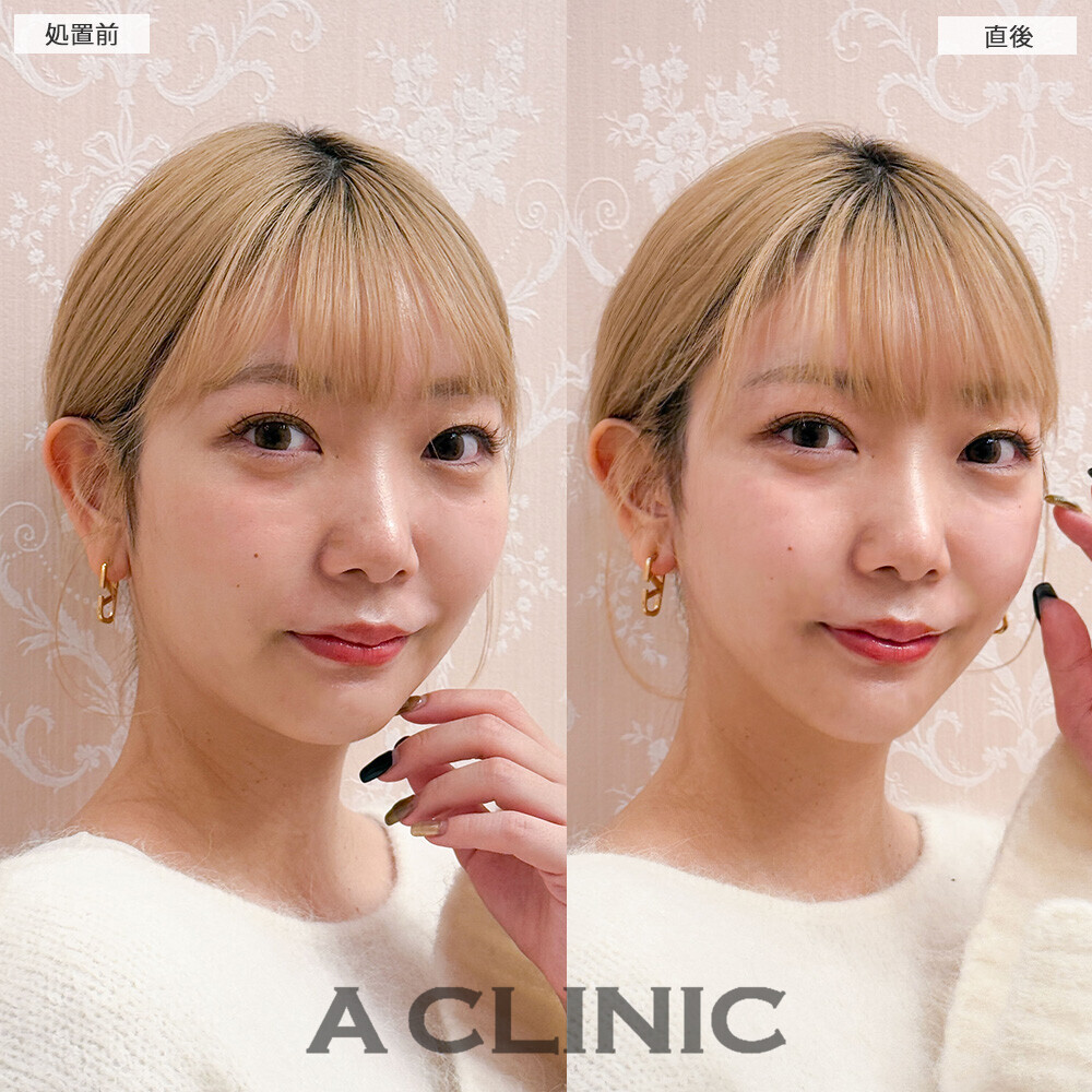 Aスレッドでリフトアップすることでより小顔になりました！こちら処置前と直後の症例です(20代女性)