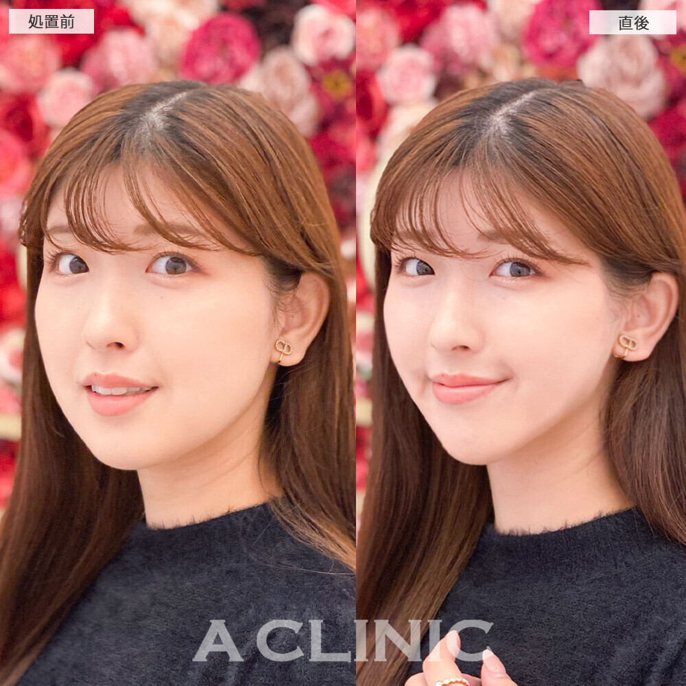 Aスレッドで顔の余白を無くしてバランスの良いお顔に！こちら処置前と直後の症例です(20代女性)