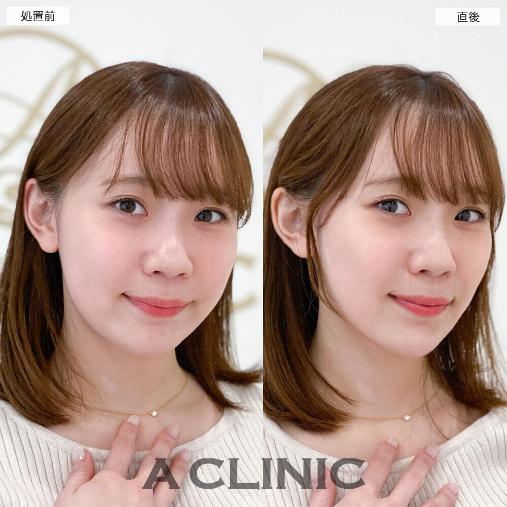 Aスレッドとあごへのヒアルロン酸注入で丸顔から卵型に変化！こちら処置前と直後の症例です(20代女性)