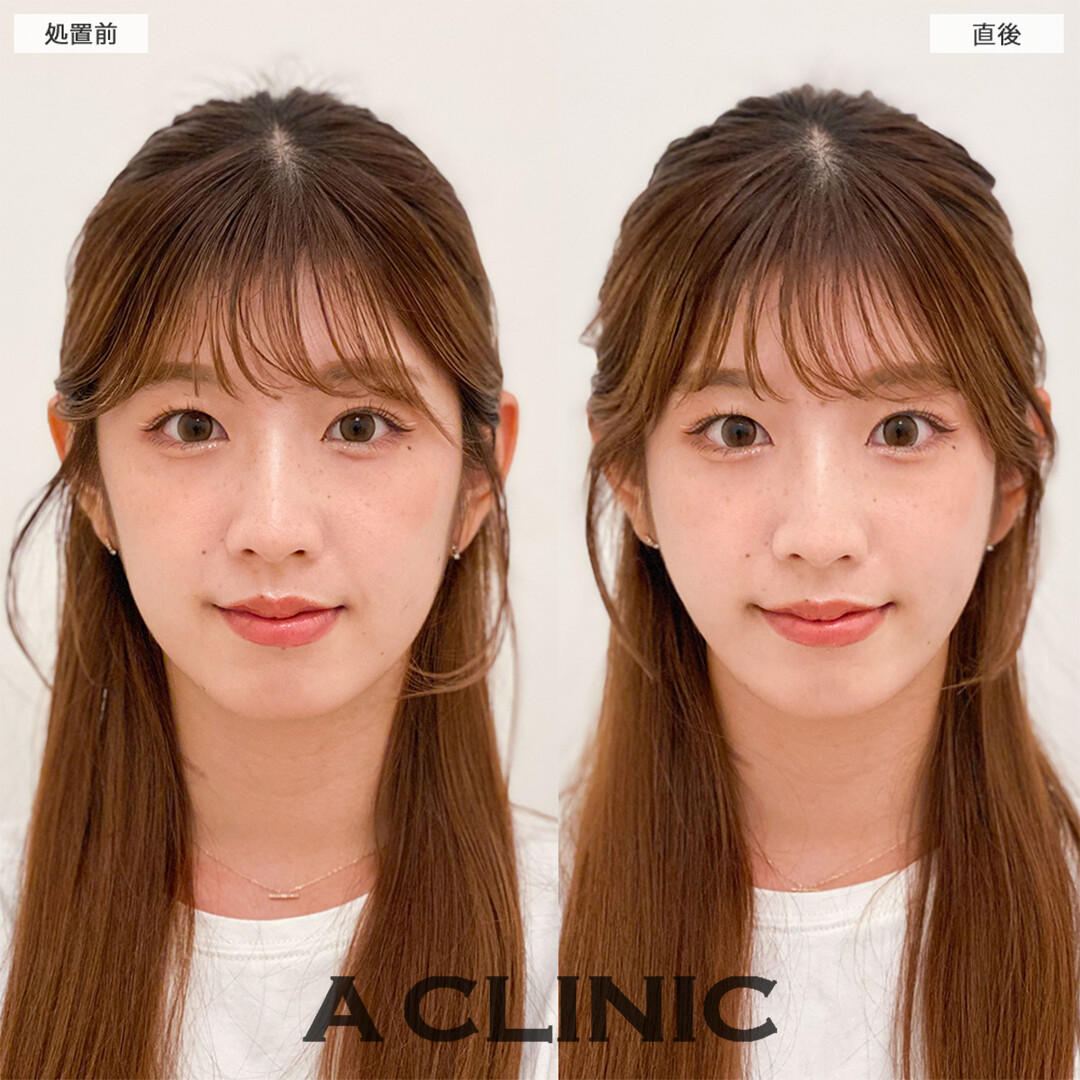 Aスレッドは輪郭の左右差も改善できます！こちら処置前と直後の症例です(20代女性)